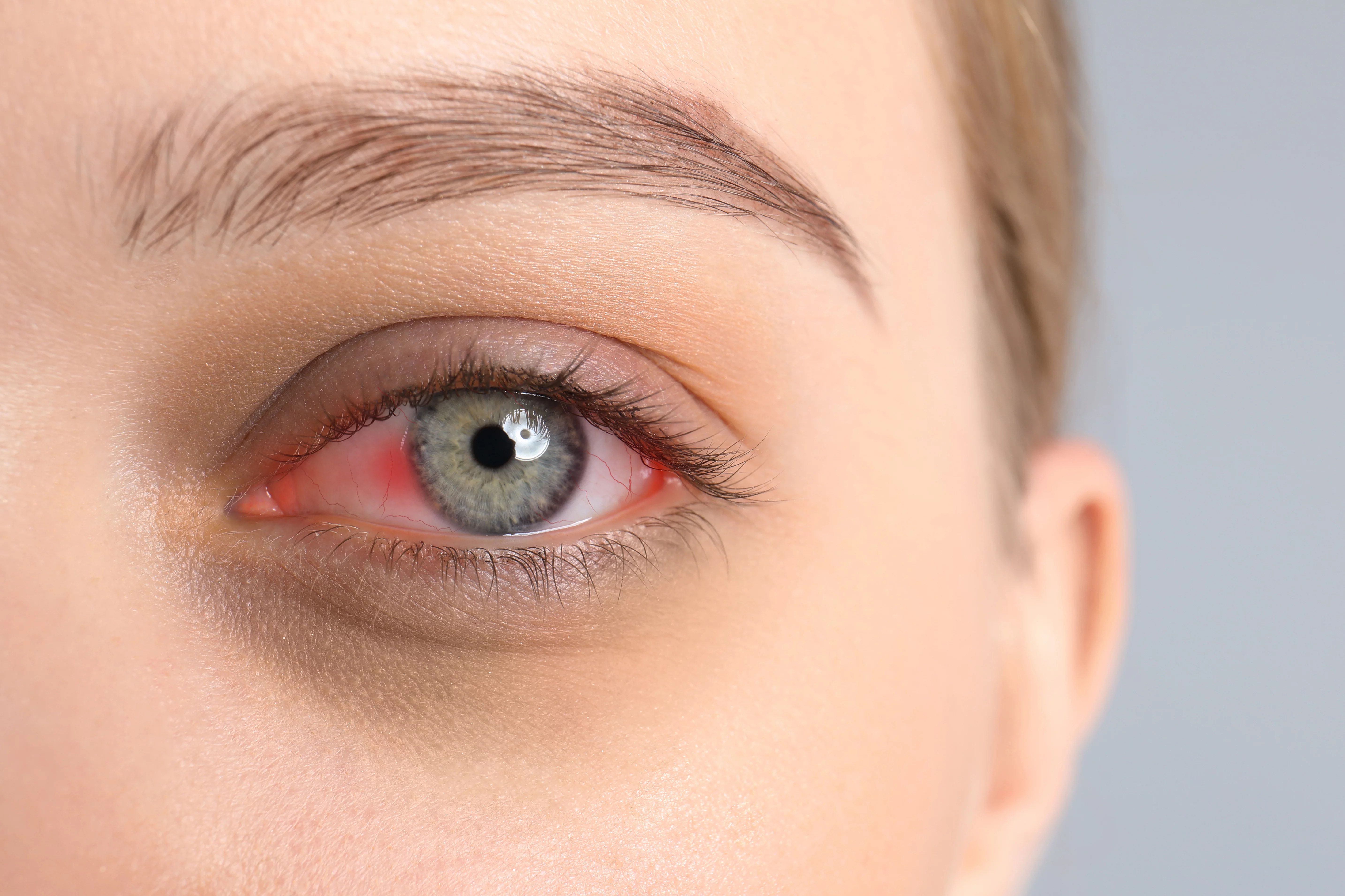 Herpes ocular