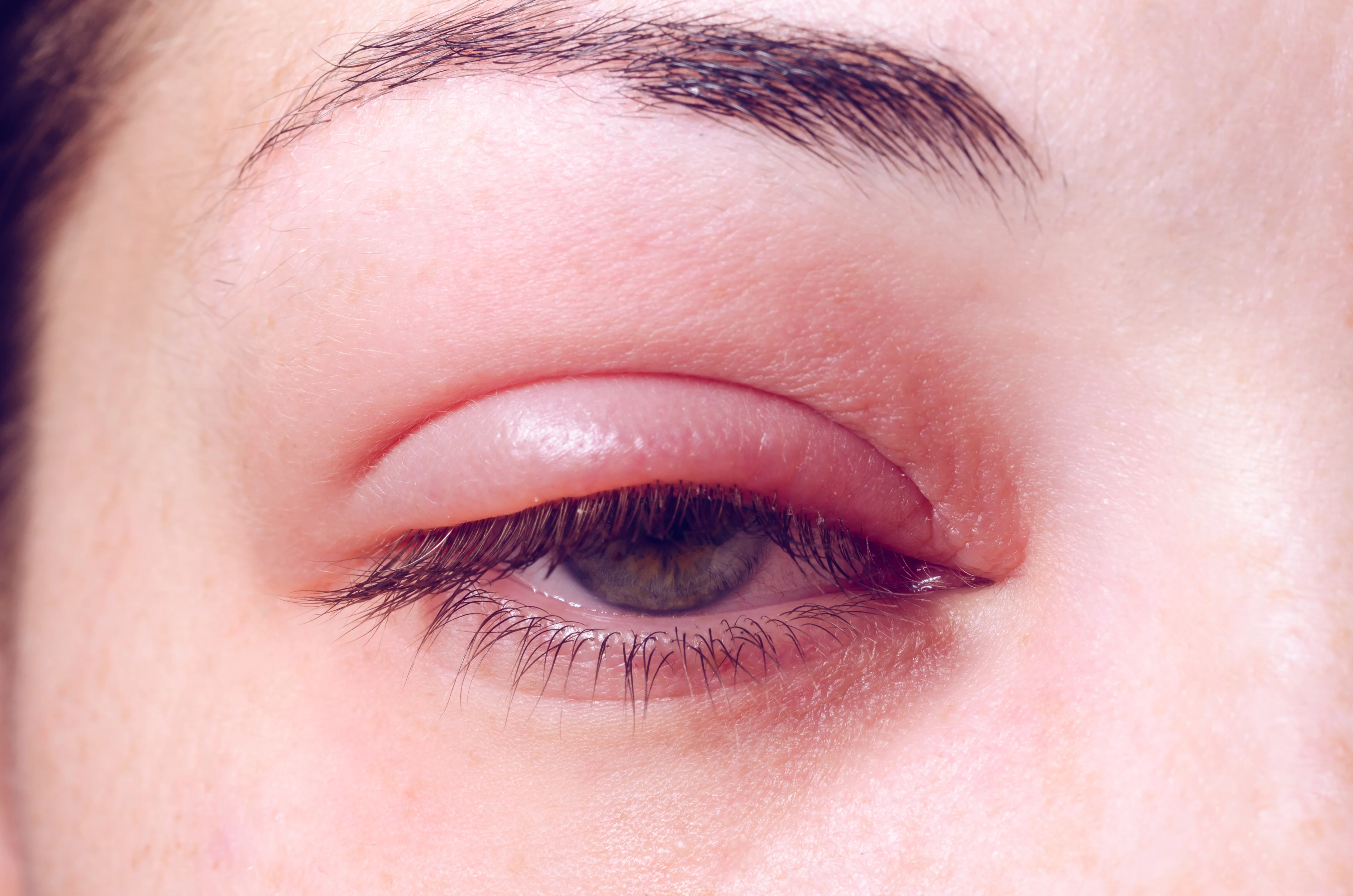 Infección ocular