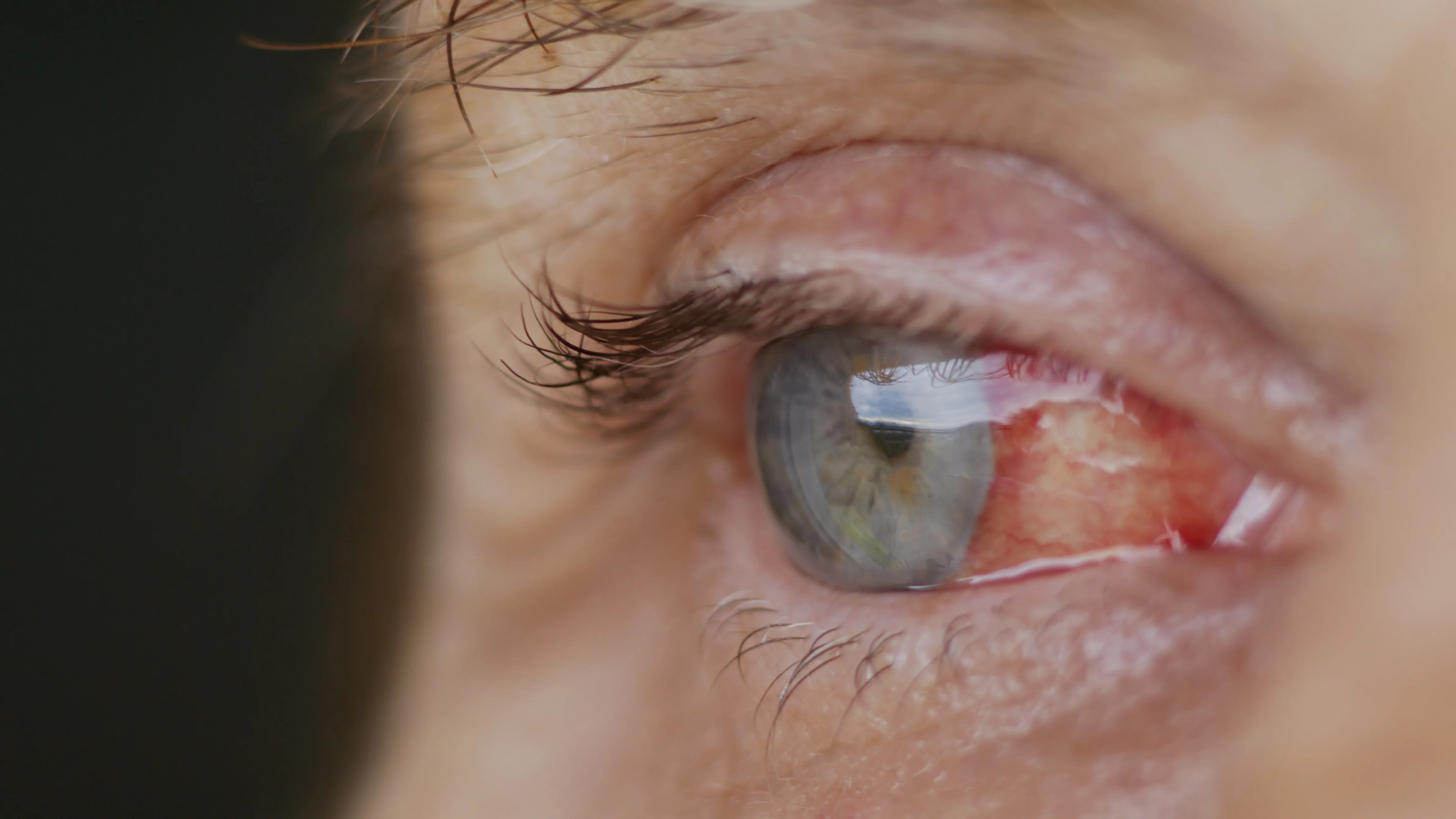 Midriasis